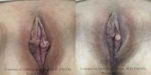 labiaplasty 5