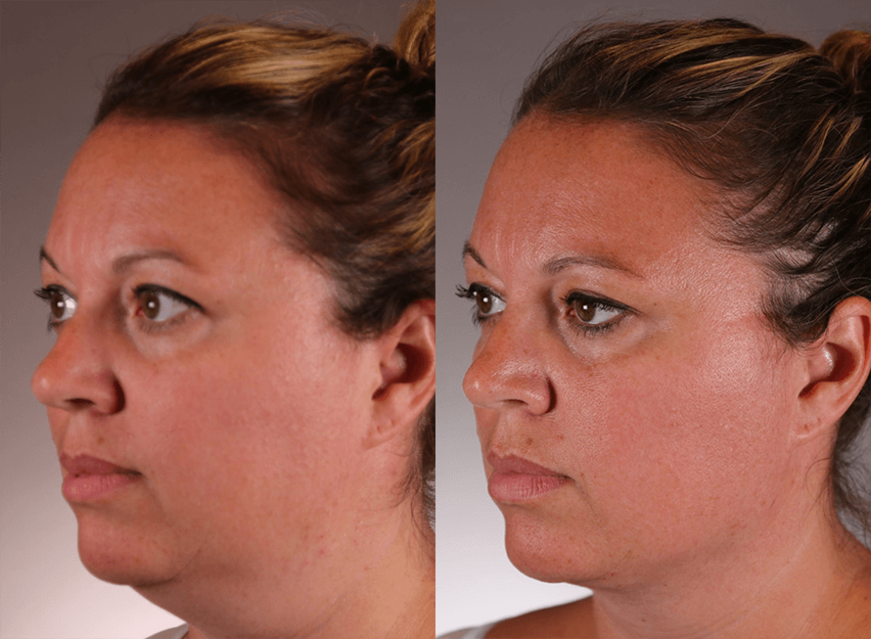 facetite 1