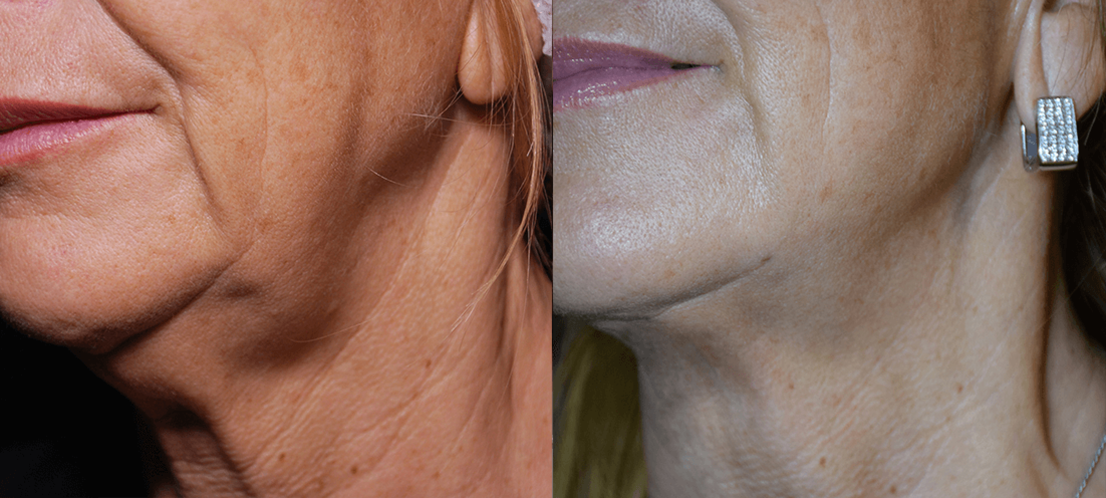 facetite 6