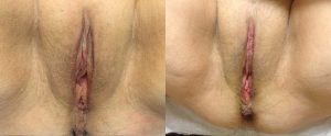 labiaplasty 2
