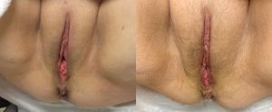 labiaplasty 3