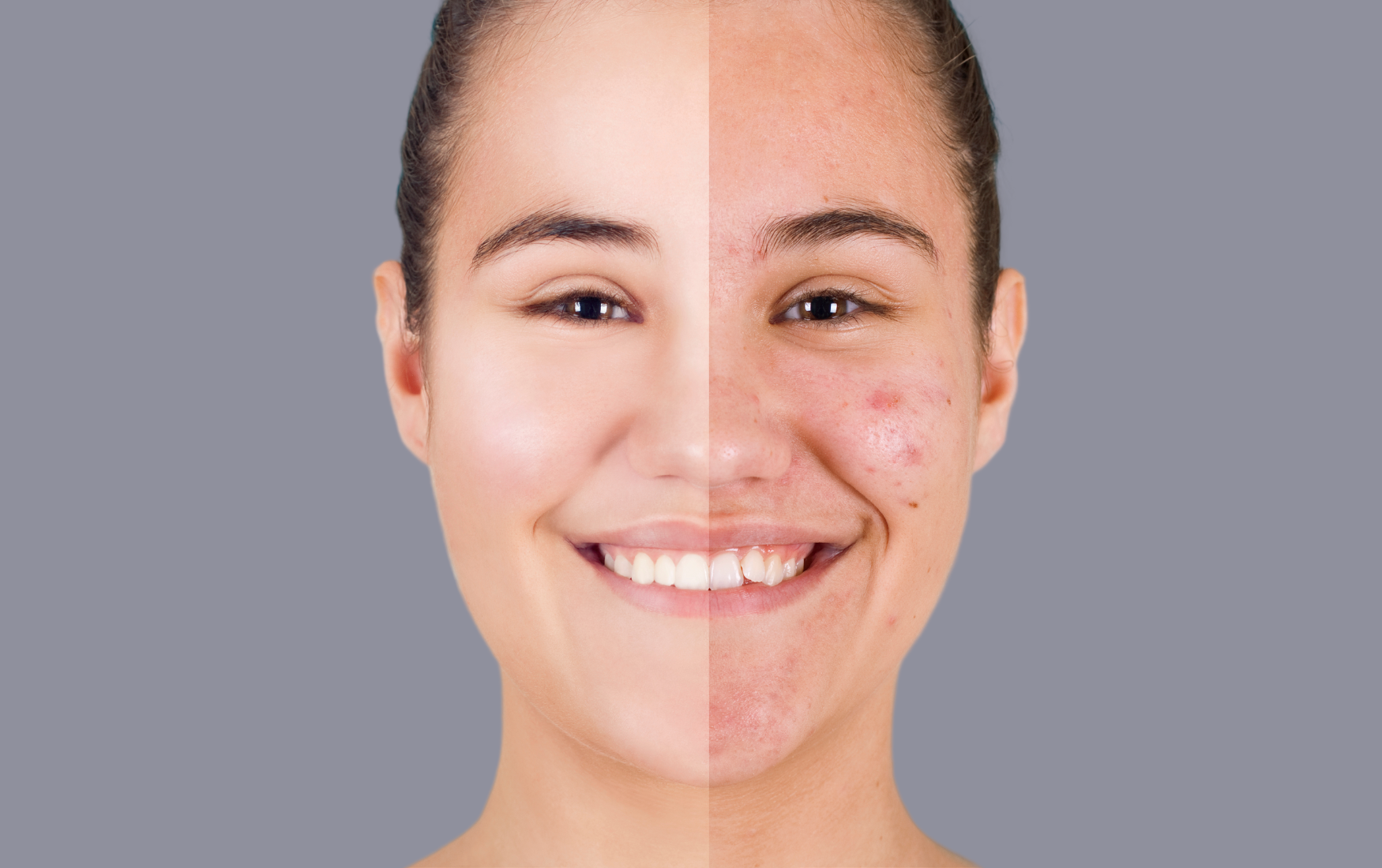 acne treatment houston