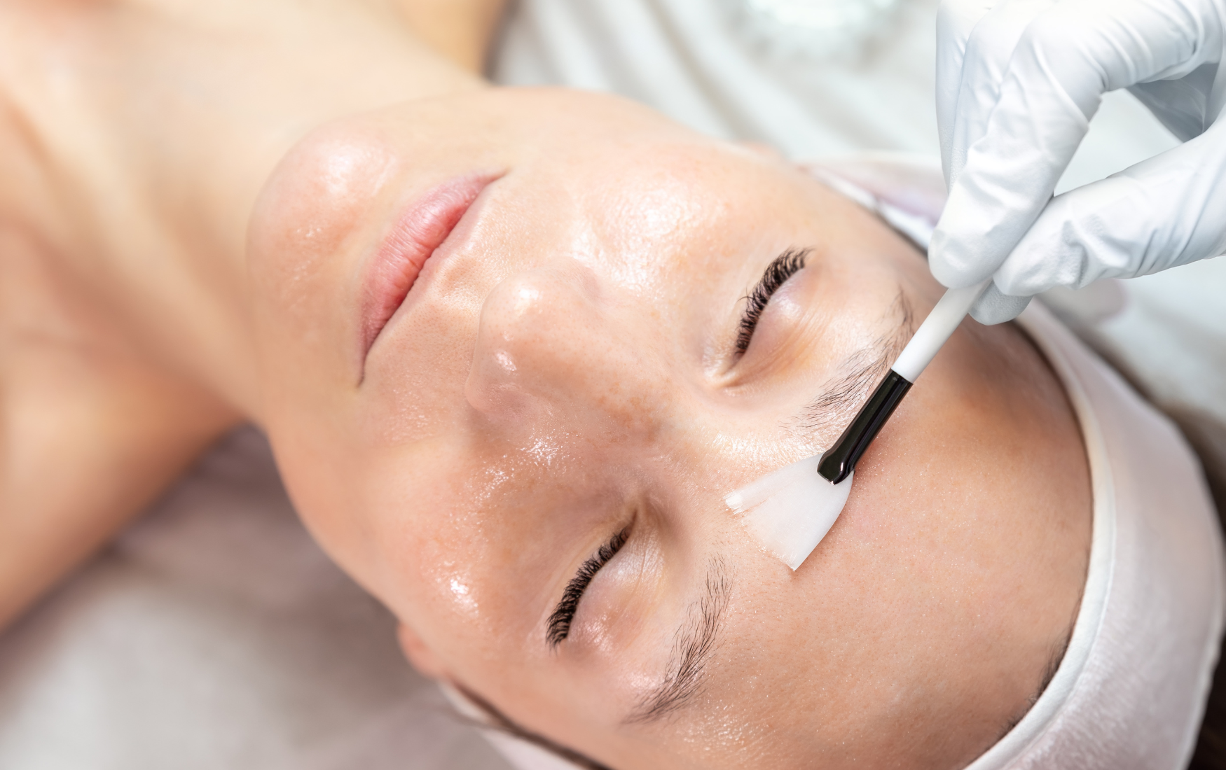 chemical peel houston