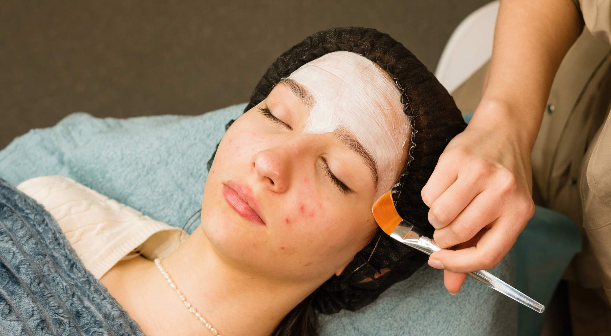 acne treatment in houston tx